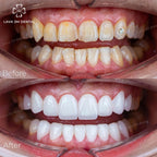 ធ្មេញសេរ៉ាមិច Orodent