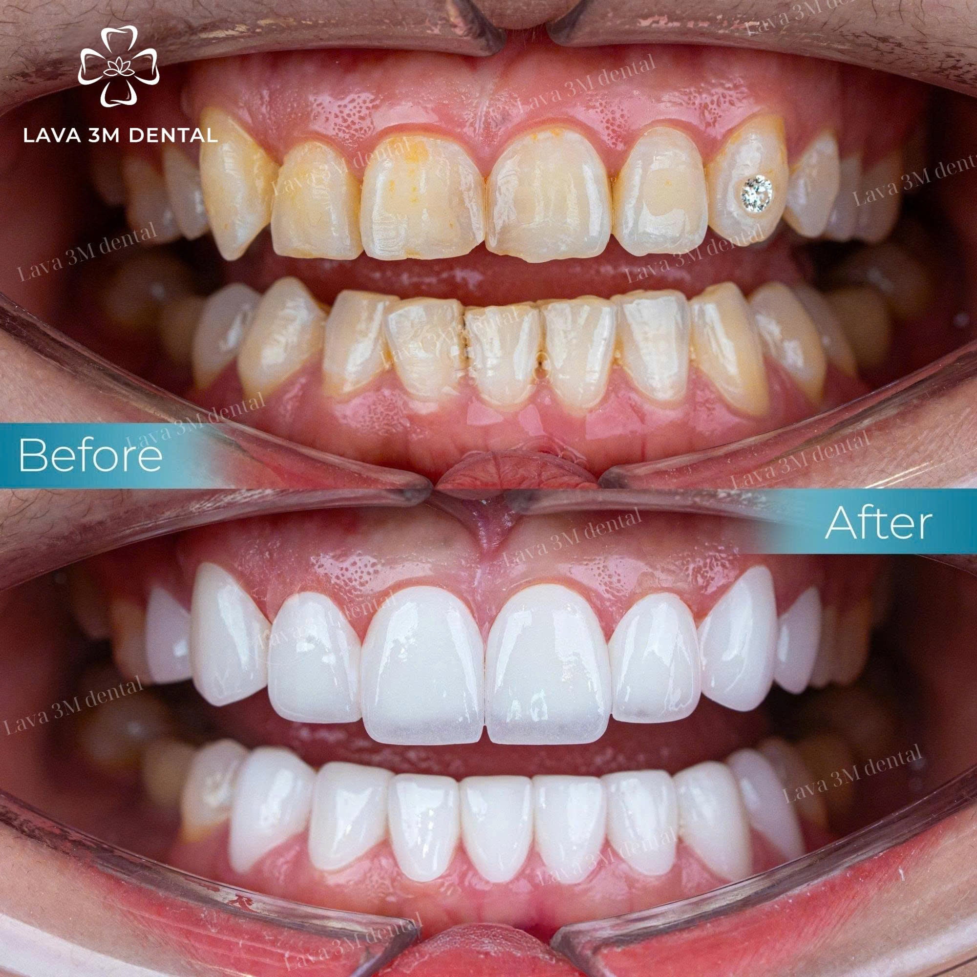 ធ្មេញសេរ៉ាមិច Orodent