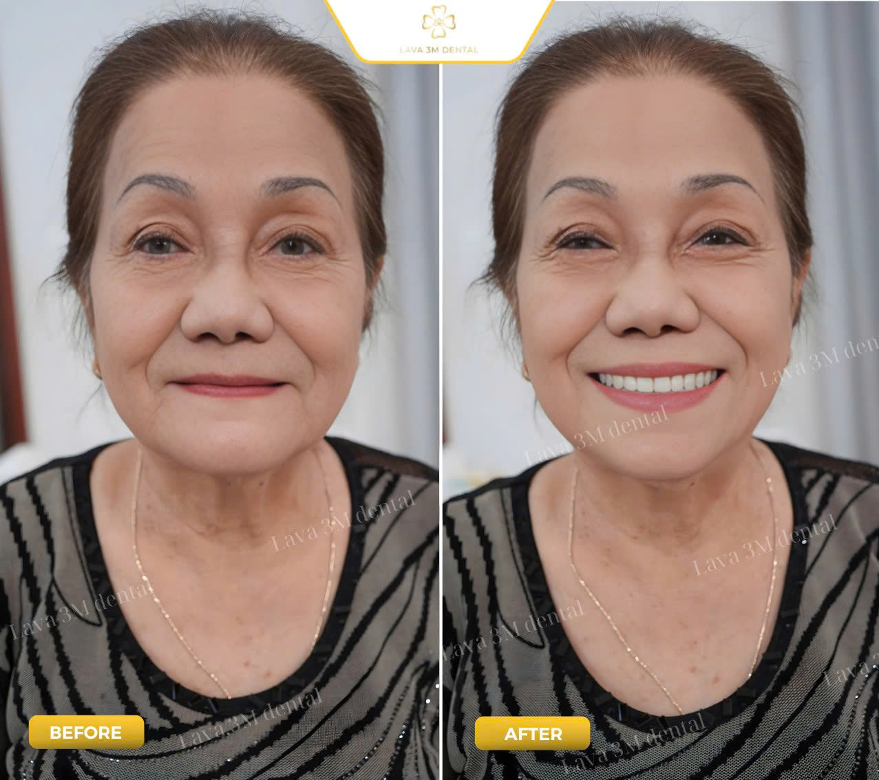 ធ្មេញជ័រដោះដាក់បាន