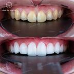 ធ្មេញសេរ៉ាមិច Saphire