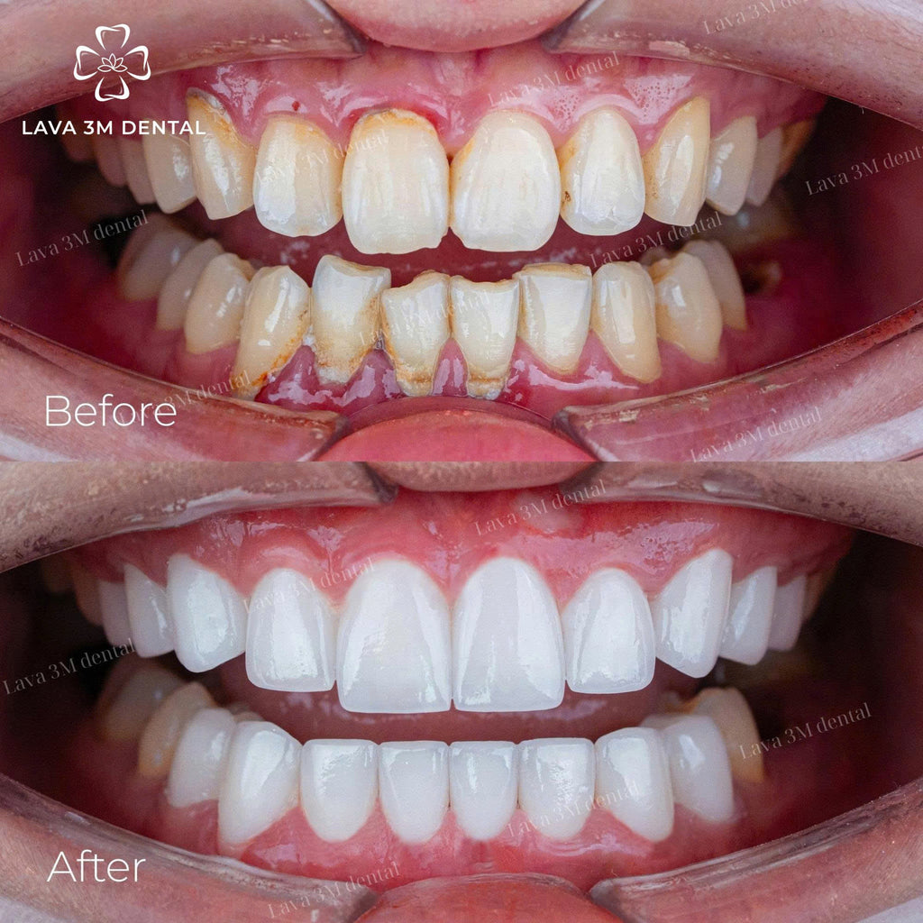 ធ្មេញសេរ៉ាមិច Cercon HT