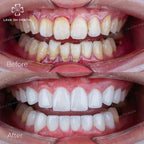 ធ្មេញសេរ៉ាមិច Cercon HT