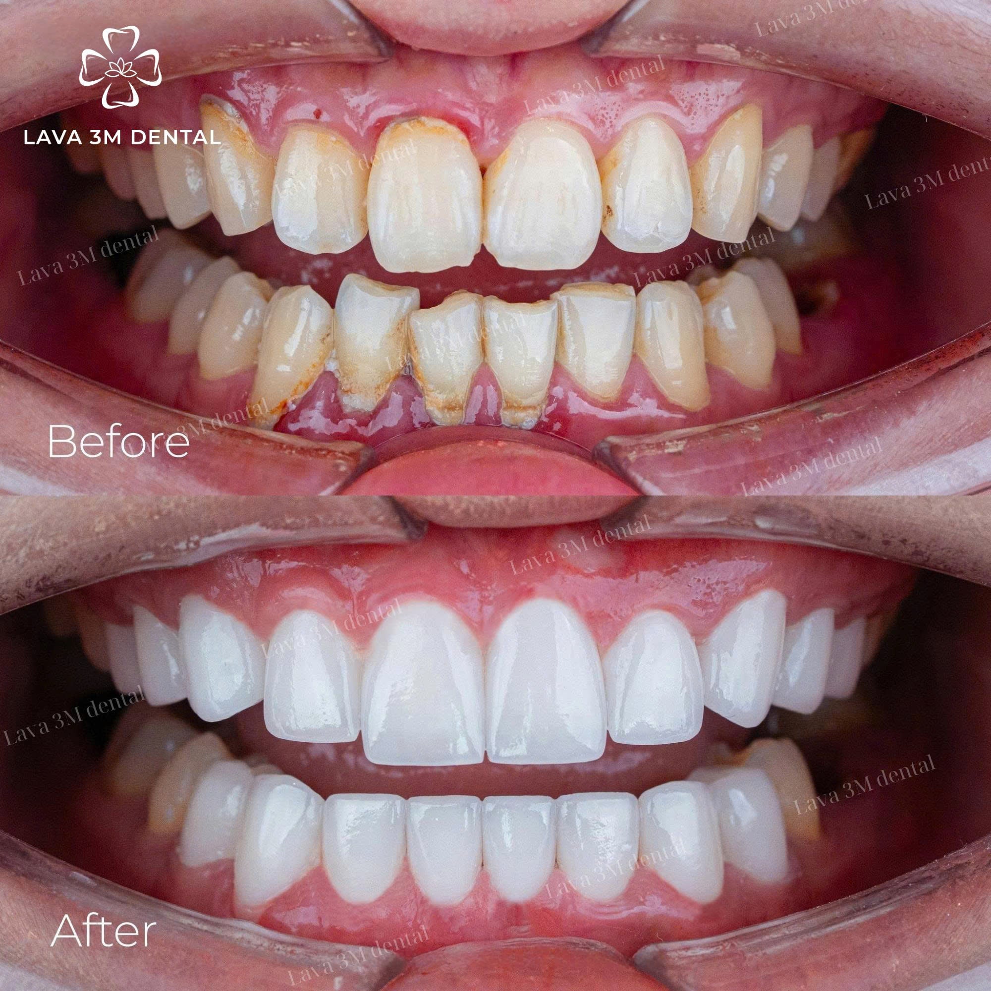 ធ្មេញសេរ៉ាមិច Cercon HT