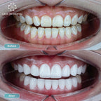 ធ្មេញសេរ៉ាមិច Cercon HT