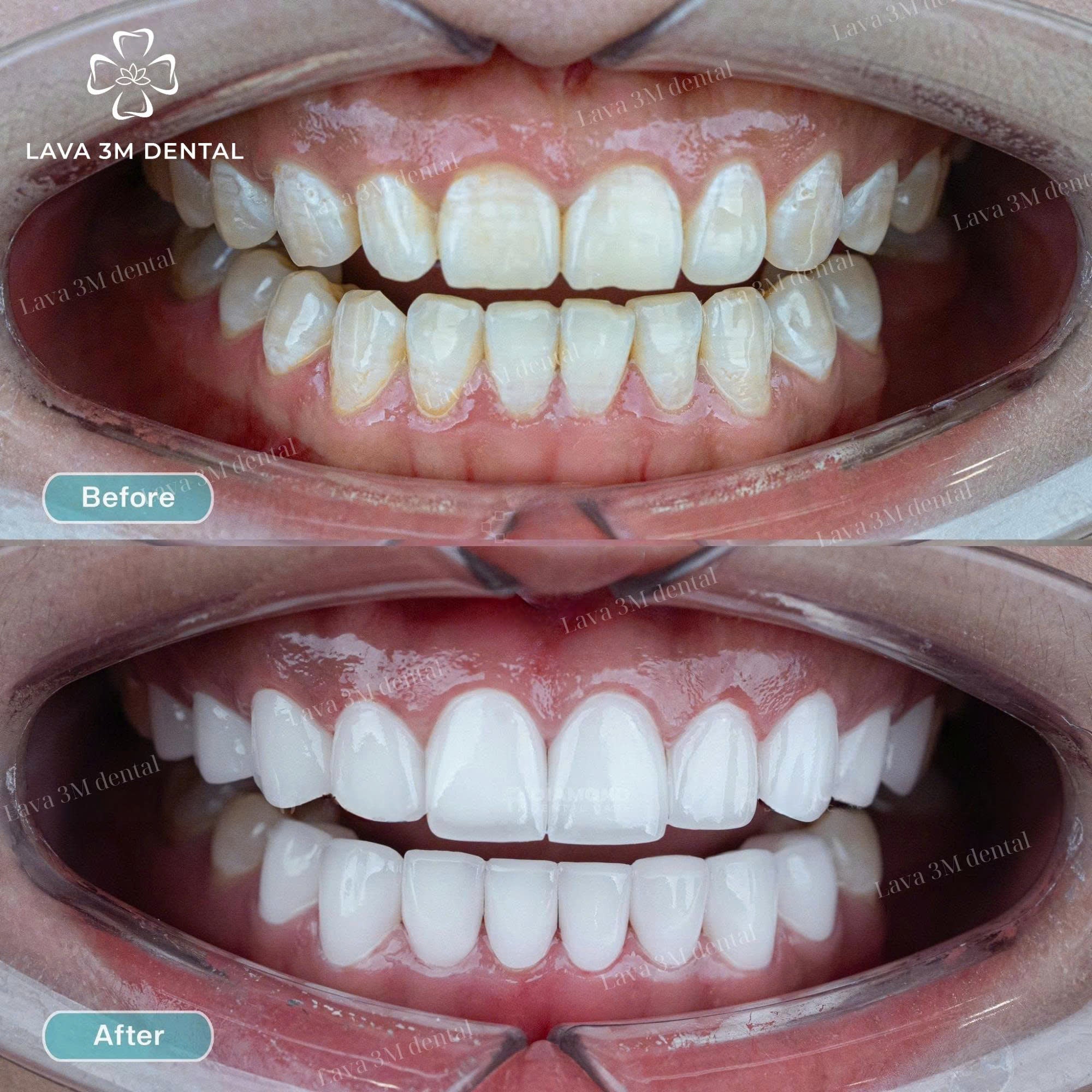 ធ្មេញសេរ៉ាមិច Cercon HT