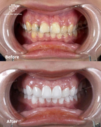 ធ្មេញសេរ៉ាមិច Zirconia