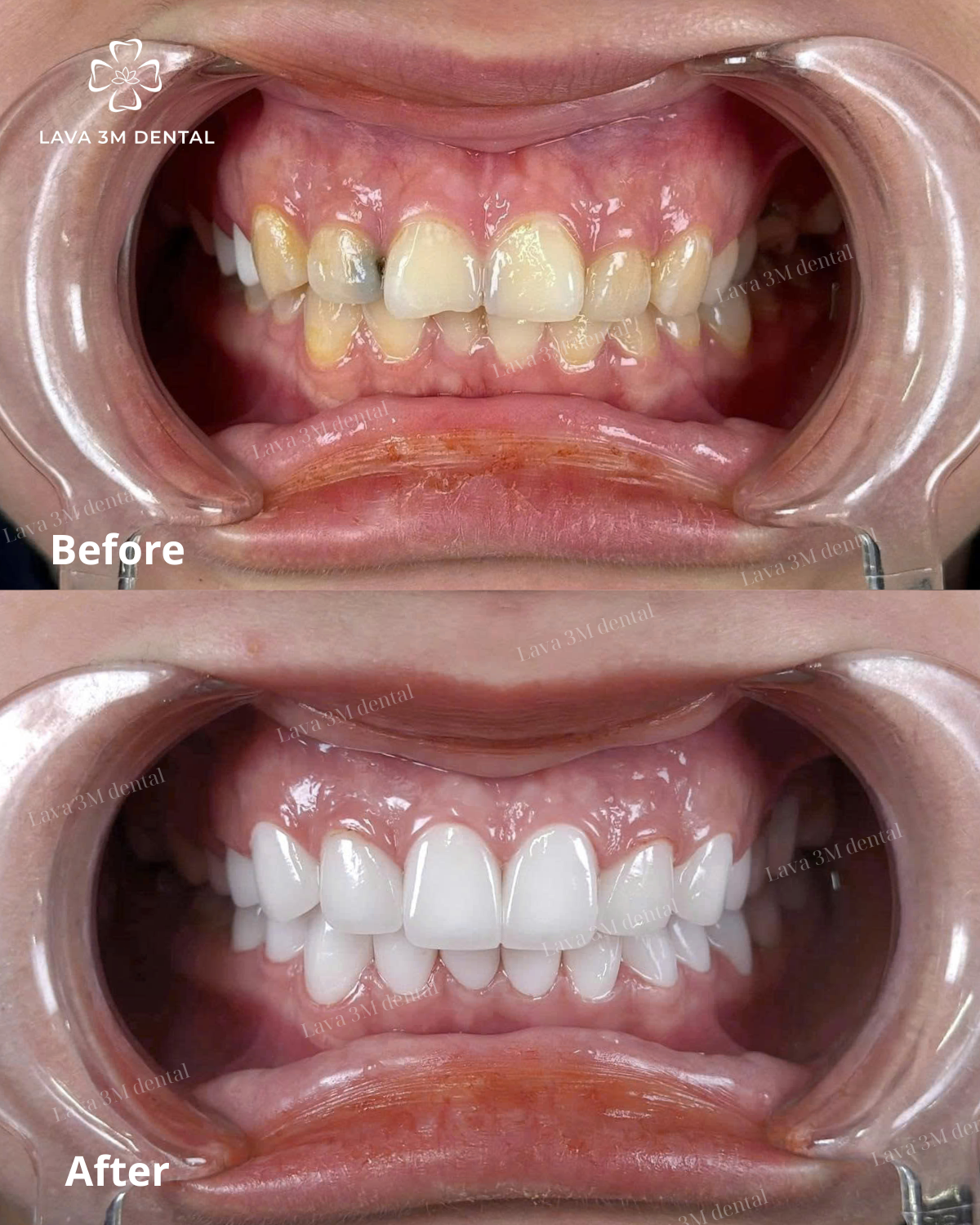 ធ្មេញសេរ៉ាមិច Zirconia