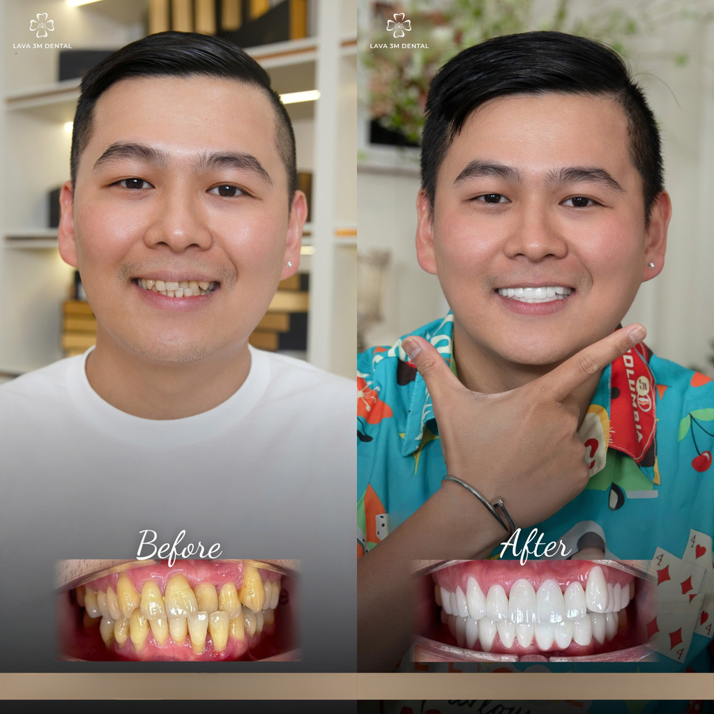 ធ្មេញសេរ៉ាមិច Zirconia