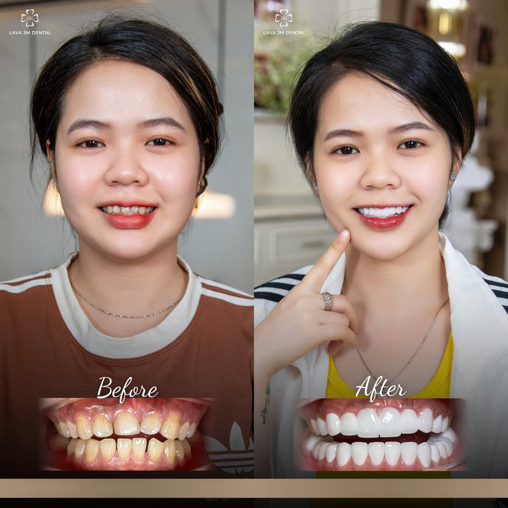 ធ្មេញសេរ៉ាមិច Cercon HT