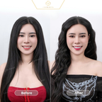 ធ្មេញសេរ៉ាមិច Zirconia
