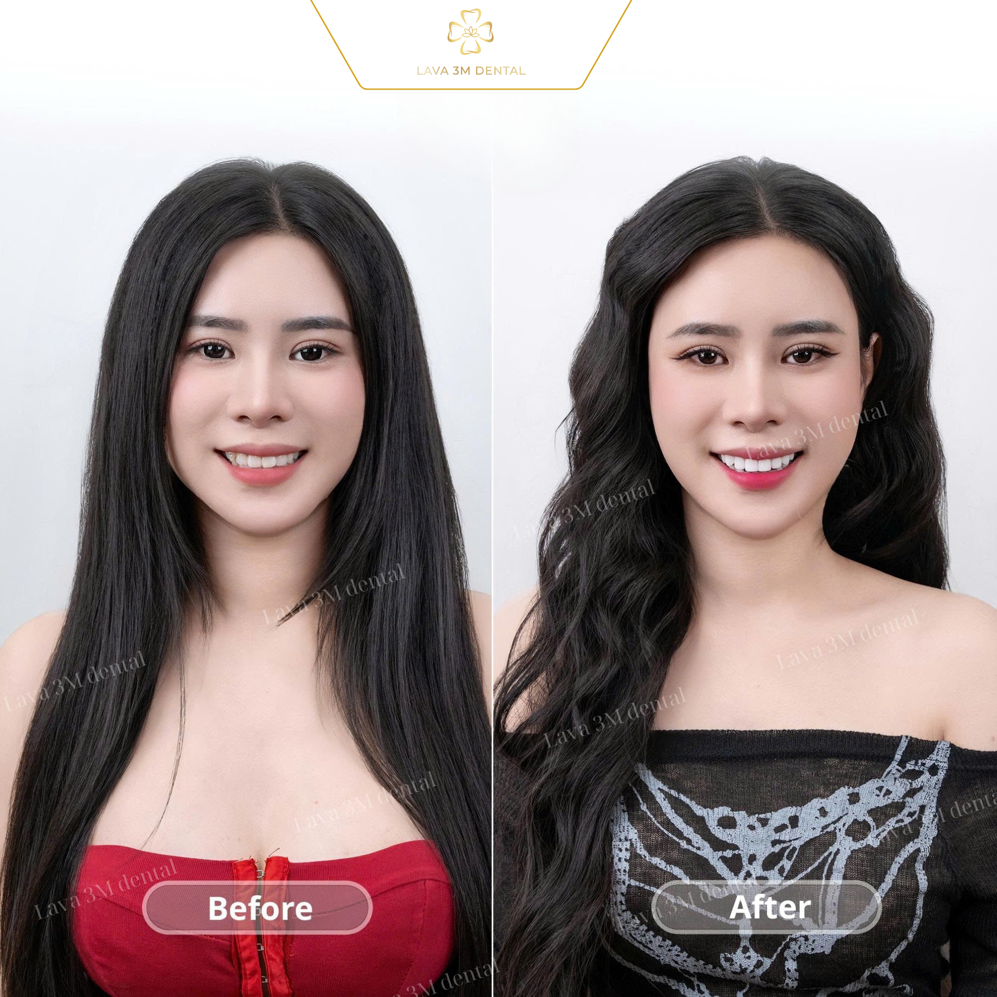 ធ្មេញសេរ៉ាមិច Zirconia