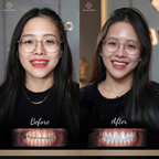 ធ្មេញសេរ៉ាមិច Saphire