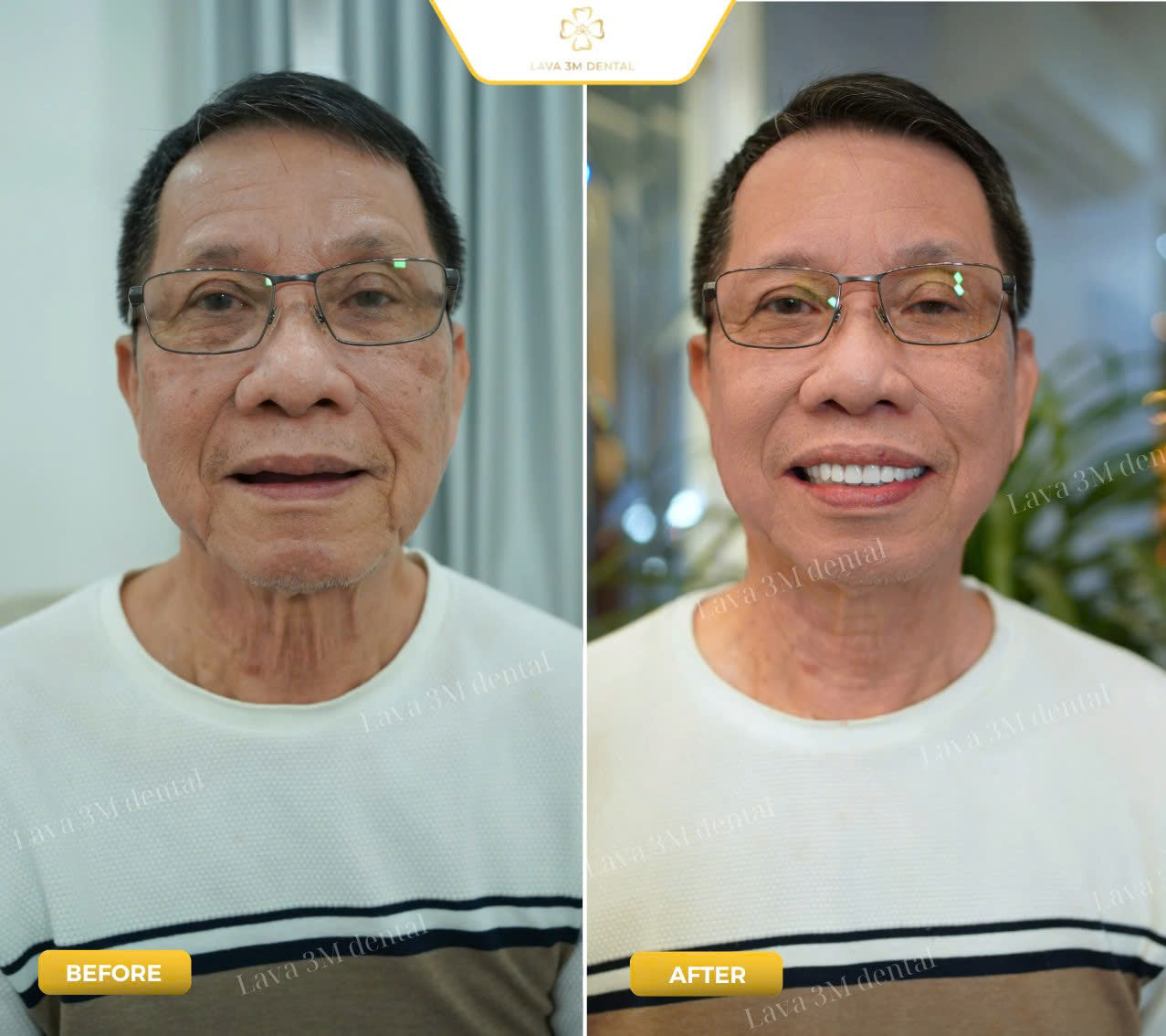 ធ្មេញស្និតដោះដាក់ប្រភេទ Composite
