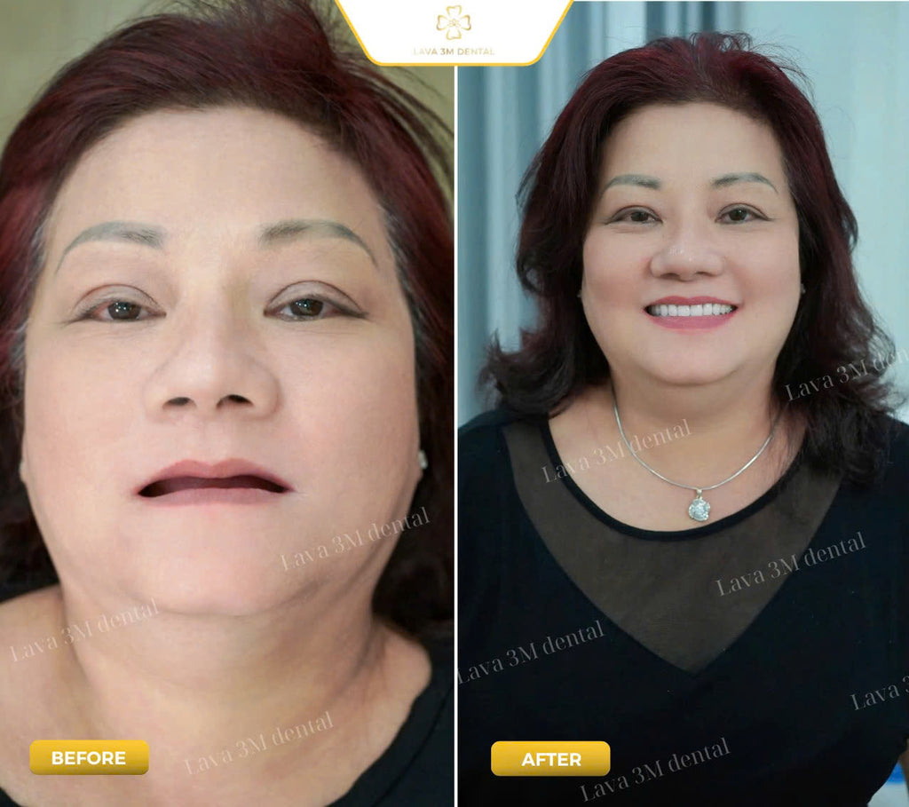 ធ្មេញស្និតដោះដាក់ប្រភេទ Composite
