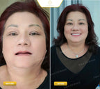ធ្មេញស្និតដោះដាក់ប្រភេទ Composite