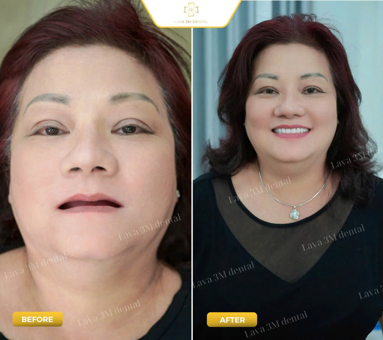 ធ្មេញស្និតដោះដាក់ប្រភេទ Composite