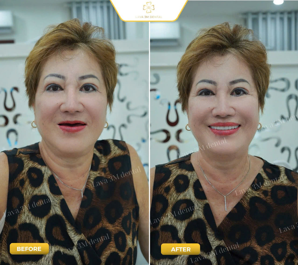 ធ្មេញស្និតដោះដាក់ប្រភេទ Composite