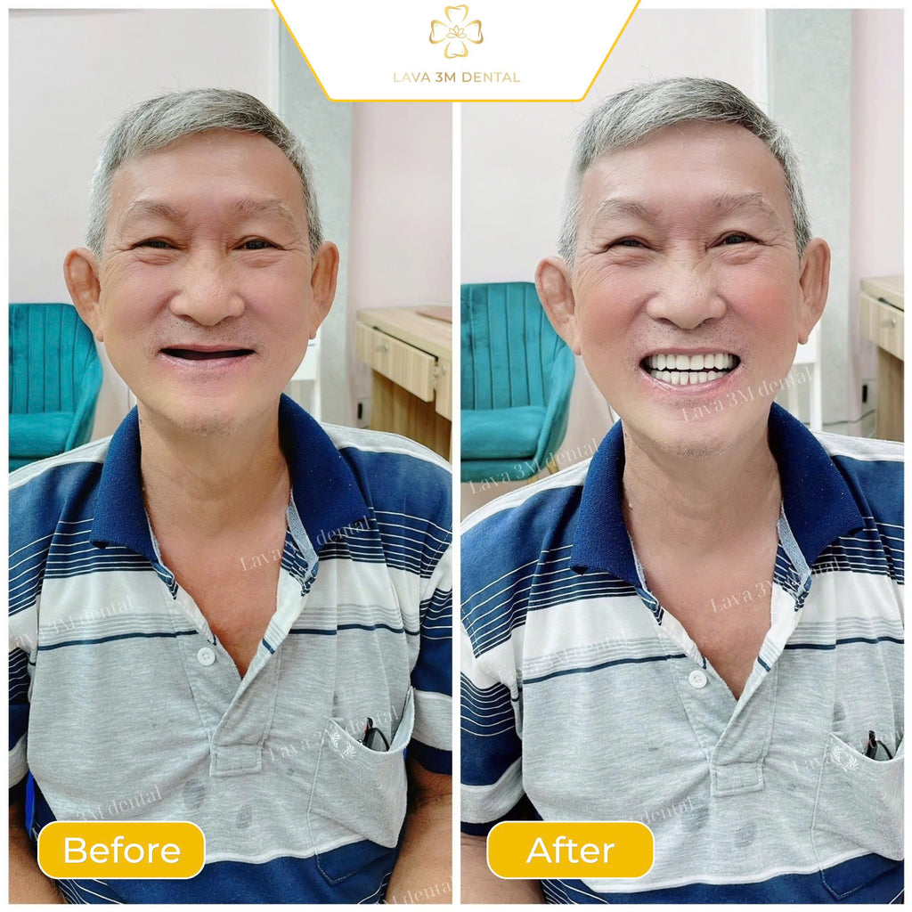 ធ្មេញស្និតដោះដាក់ប្រភេទ Composite