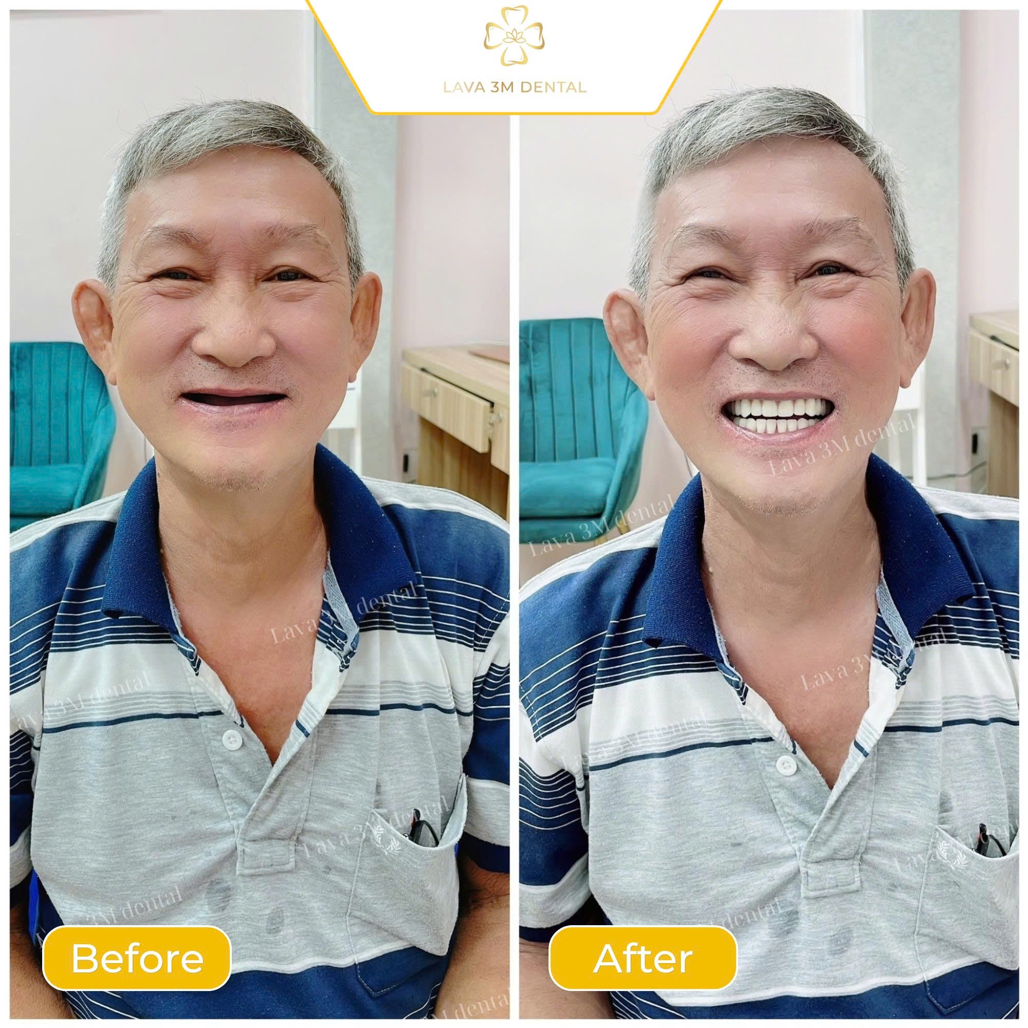 ធ្មេញស្និតដោះដាក់ប្រភេទ Composite