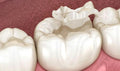 ការប៉ះធ្មេញ Composite