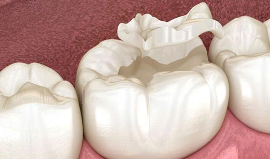 ការប៉ះធ្មេញ Composite