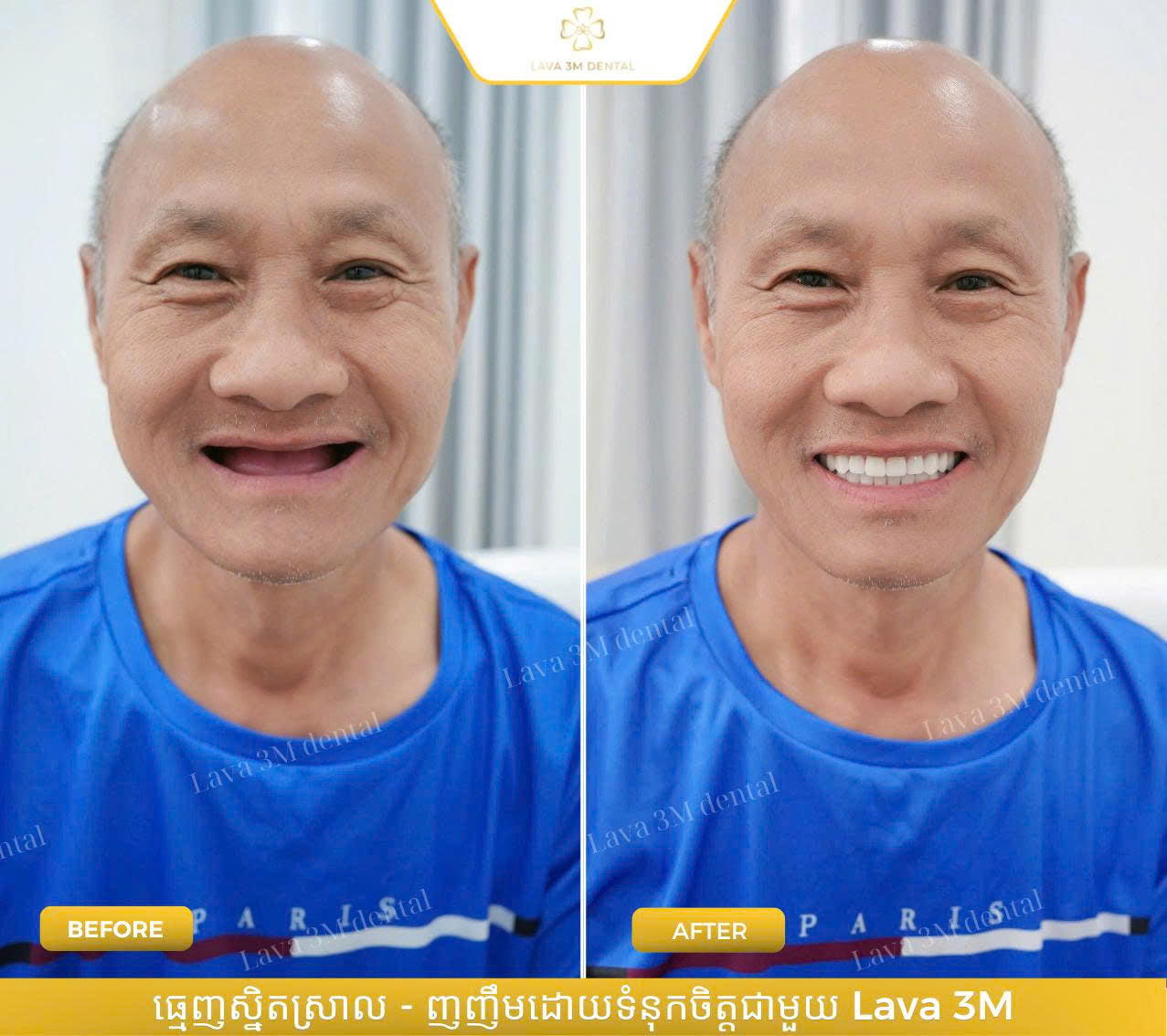 ធ្មេញស្និតដោះដាក់ប្រភេទ Composite