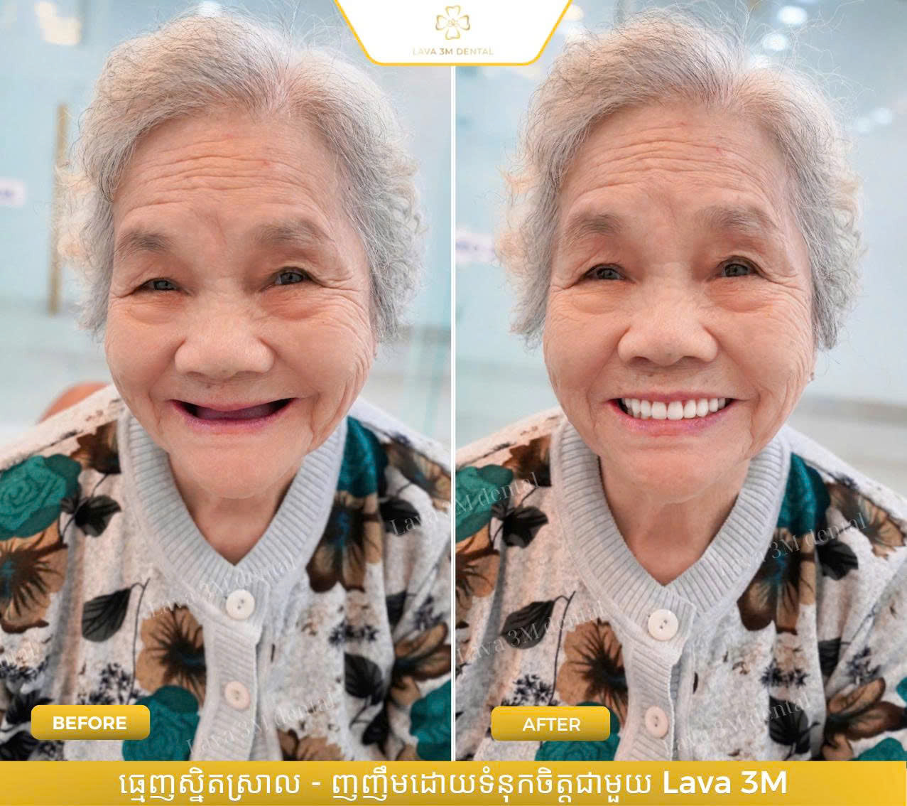 ធ្មេញជ័រដោះដាក់បាន