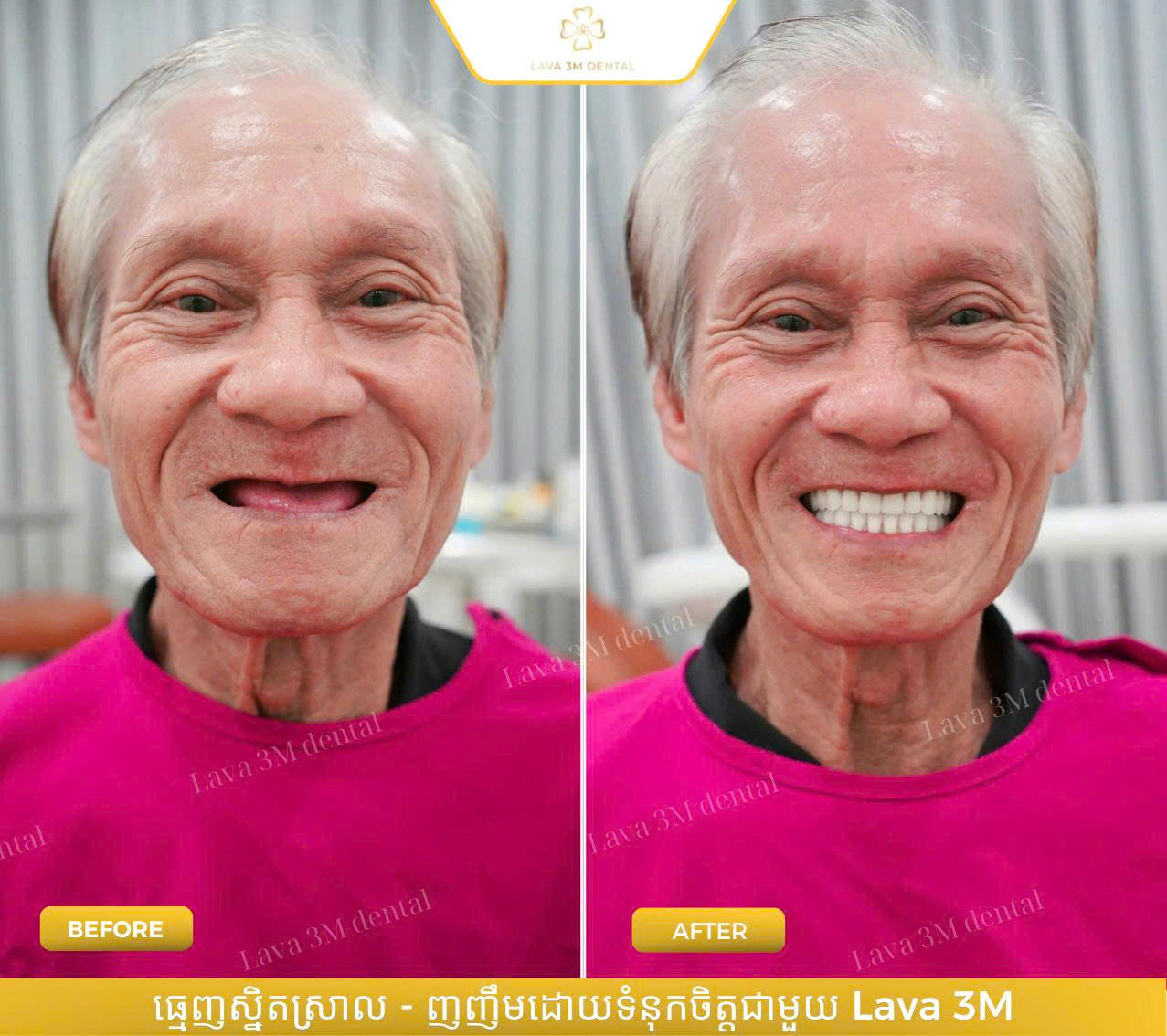 ធ្មេញជ័រដោះដាក់បាន