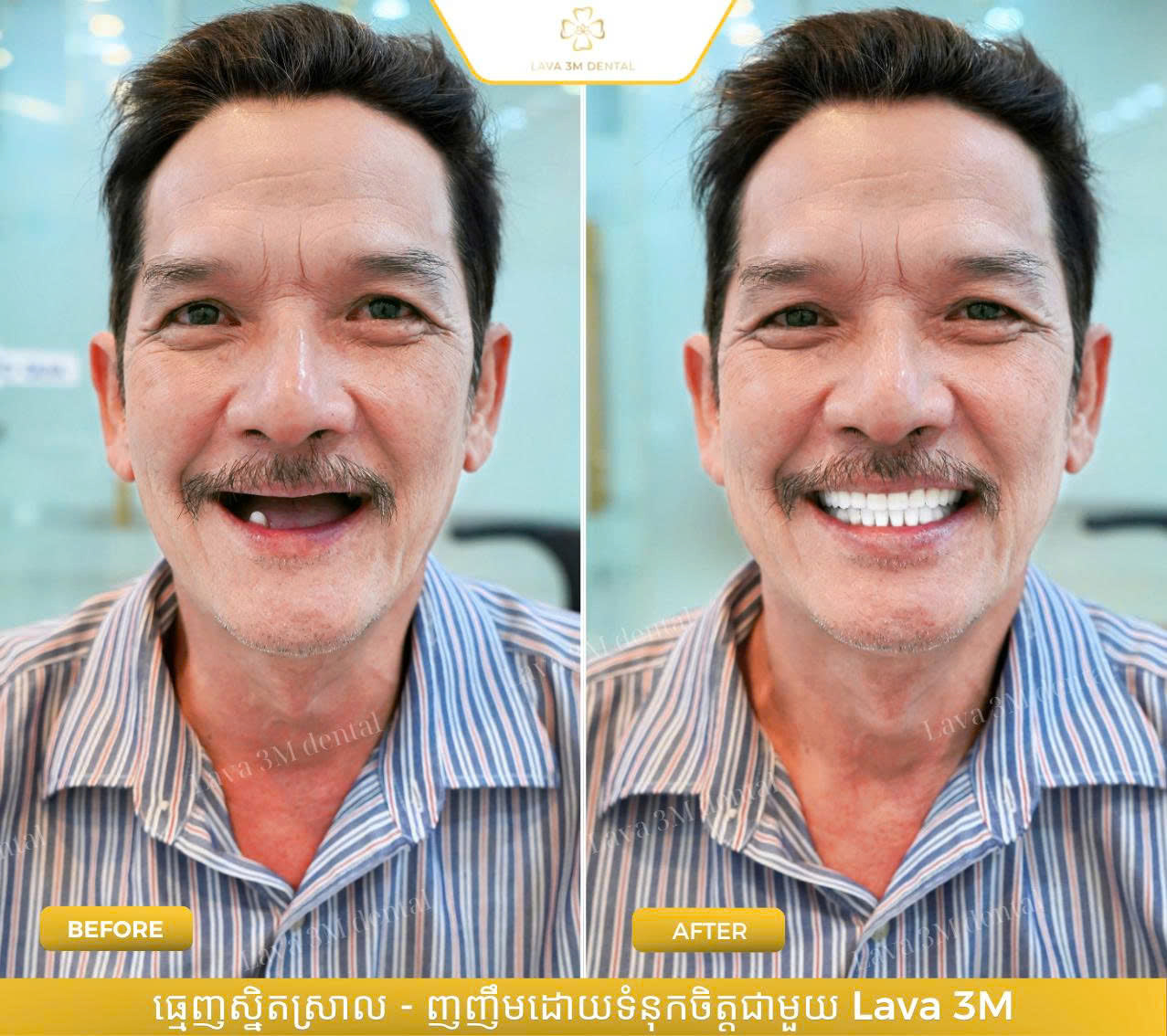 ធ្មេញស្និតប្រភេទសេរ៉ាមិច