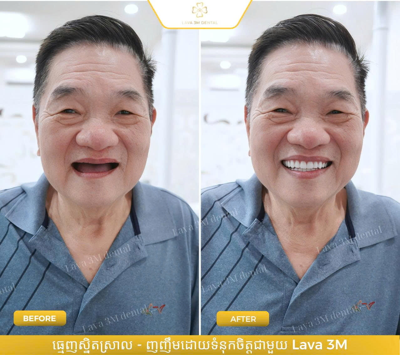 ធ្មេញជ័រដោះដាក់បាន