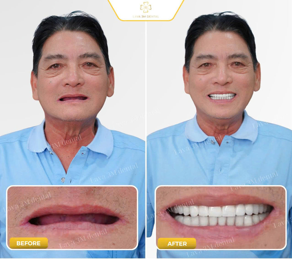 ធ្មេញស្និតប្រភេទសេរ៉ាមិច