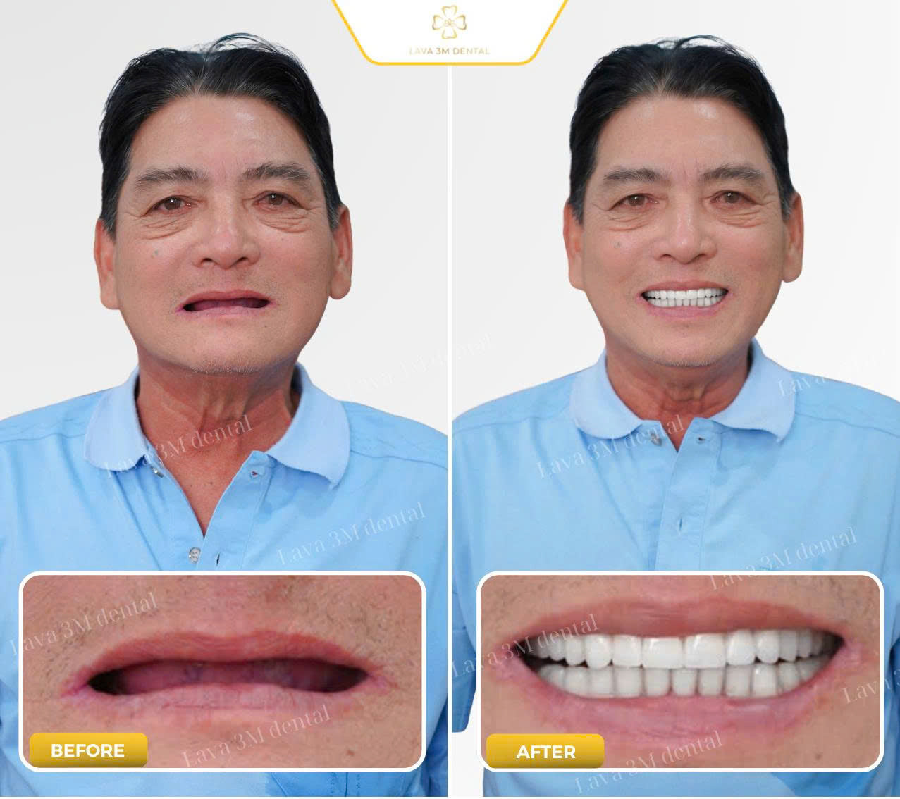 ធ្មេញស្និតប្រភេទសេរ៉ាមិច