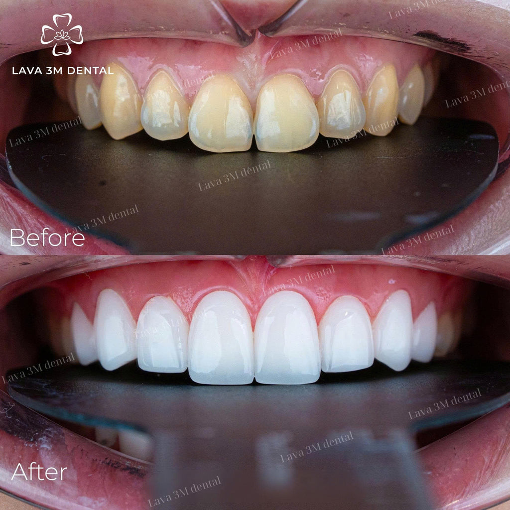 ធ្មេញសេរ៉ាមិច Orodent