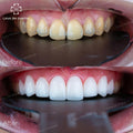 ធ្មេញសេរ៉ាមិច Orodent