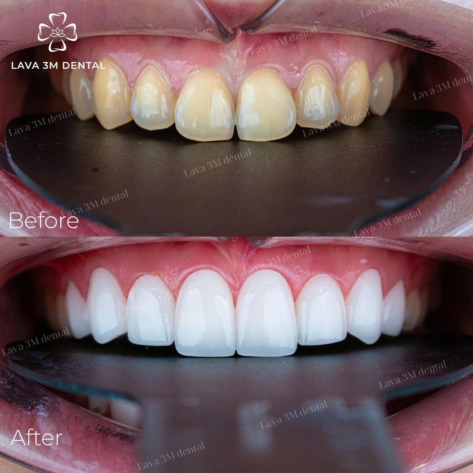 ធ្មេញសេរ៉ាមិច Orodent
