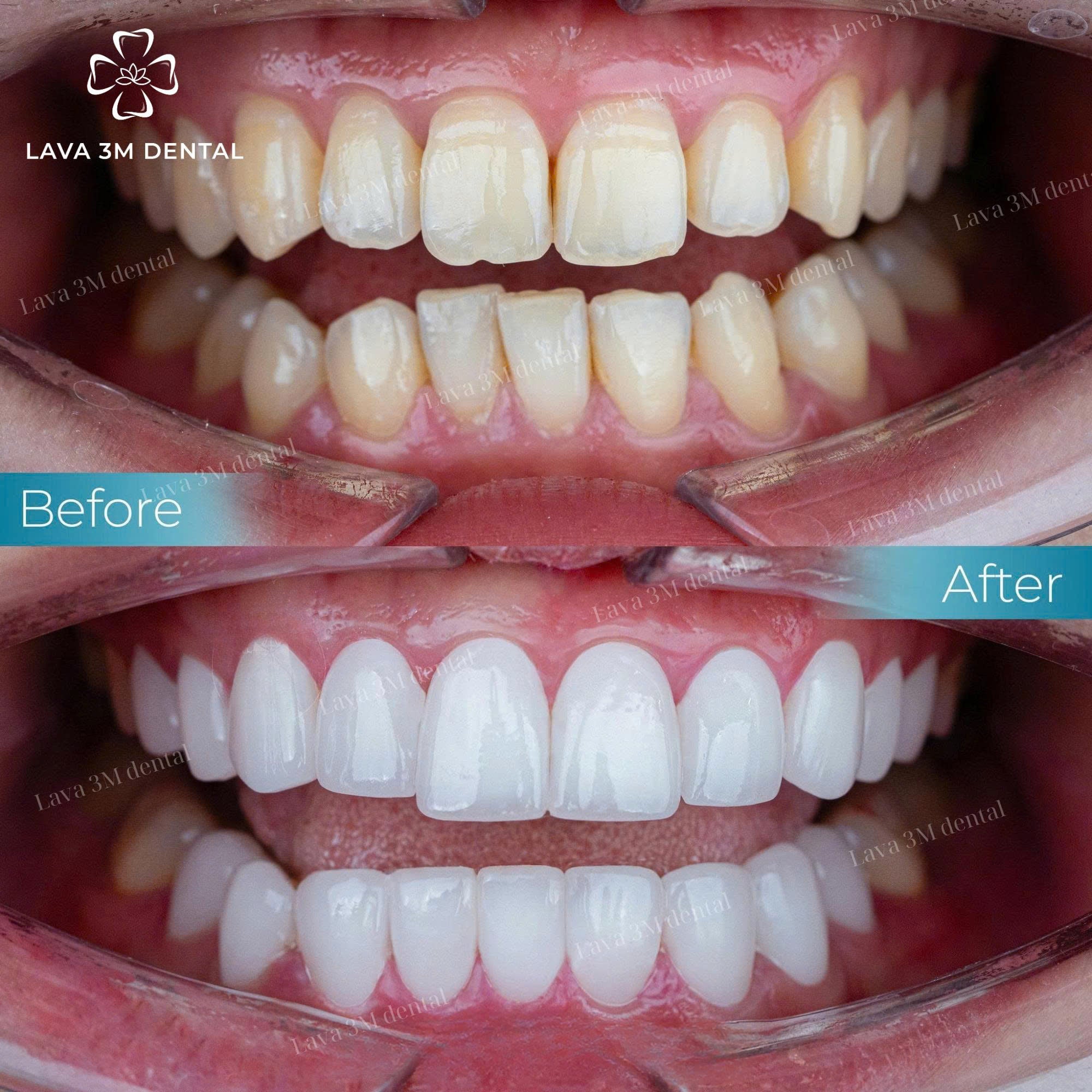 ធ្មេញសេរ៉ាមិច Cercon HT