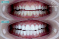 ធ្មេញសេរ៉ាមិច Zirconia