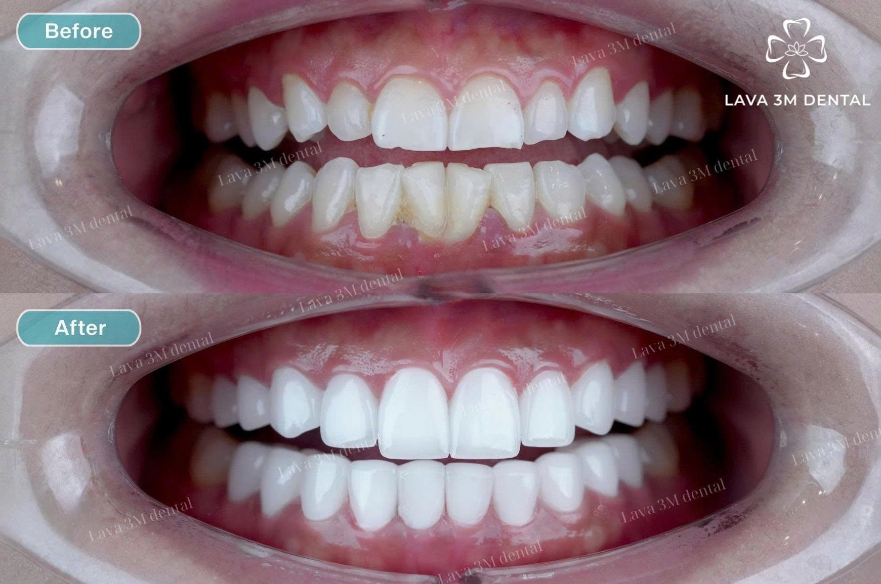 ធ្មេញសេរ៉ាមិច Zirconia