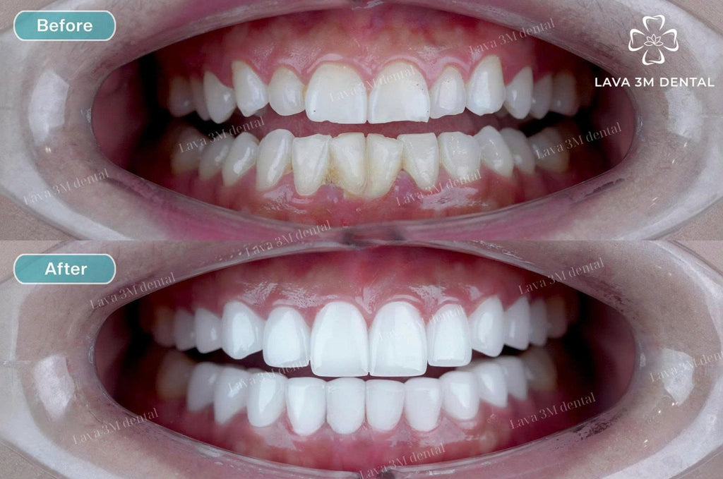 ធ្មេញសេរ៉ាមិច Zirconia