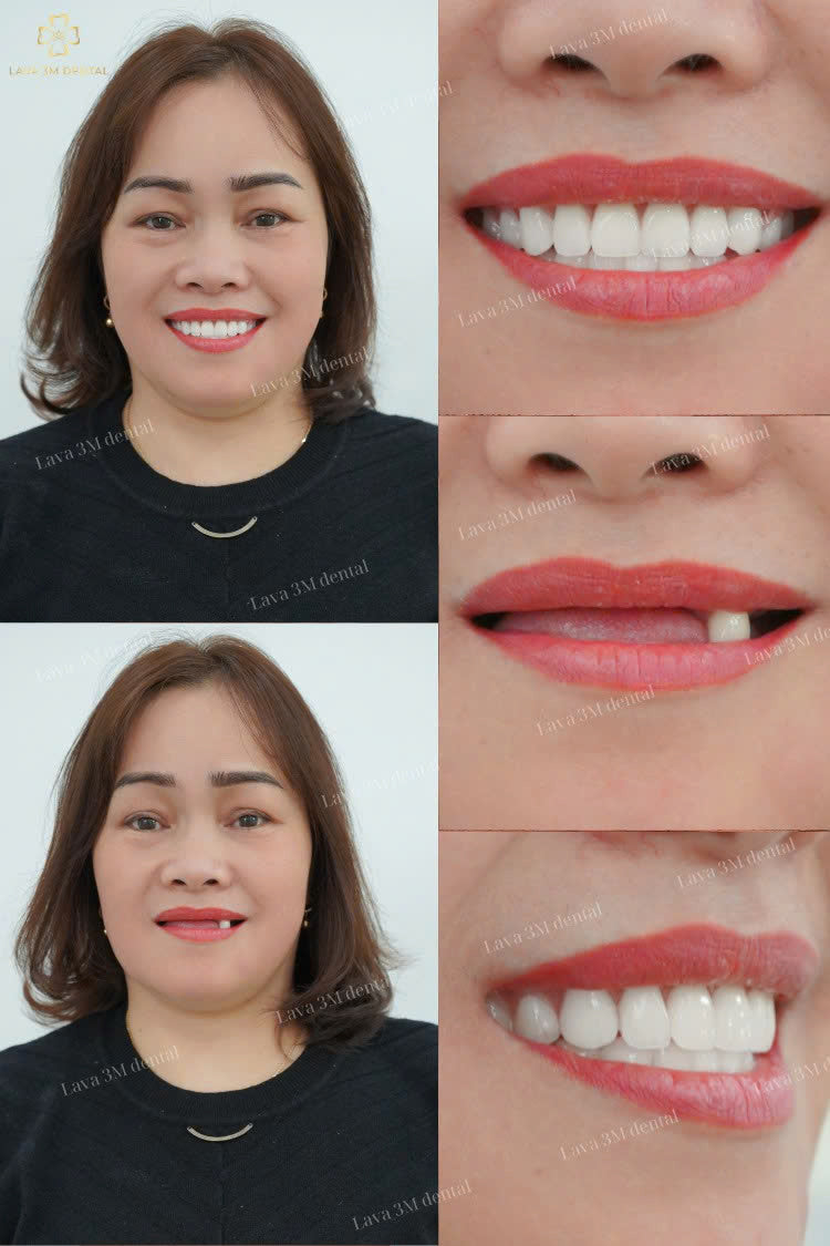 ធ្មេញជ័រដោះដាក់បាន